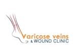 varicose-veins-laser
